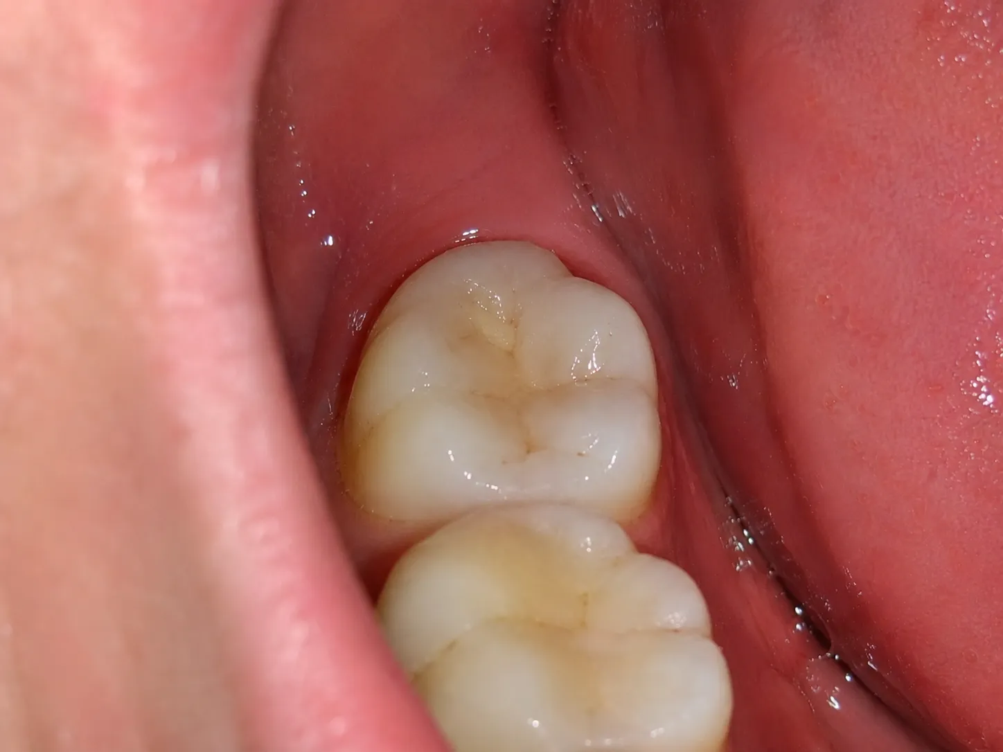 After – restored natural-looking tooth